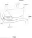 Fig. 06 - Systems, devices and methods for the creation of a therapeutic restriction in the gastrointestinal tract