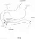 Fig. 07 - Systems, devices and methods for the creation of a therapeutic restriction in the gastrointestinal tract