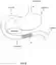 Fig. 09 - Systems, devices and methods for the creation of a therapeutic restriction in the gastrointestinal tract