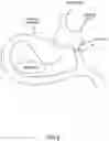 Fig. 10 - Systems, devices and methods for the creation of a therapeutic restriction in the gastrointestinal tract