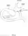 Fig. 11 - Systems, devices and methods for the creation of a therapeutic restriction in the gastrointestinal tract