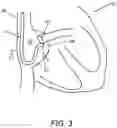 Fig. 03 - APPARATUS, SYSTEMS, AND METHODS FOR HIS BUNDLE LEAD PLACEMENT