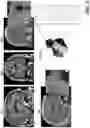 Fig. 04 - Patient-specific local field potential model