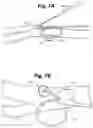 Fig. 07 - Implant tool and improved electrode design for minimally invasive procedure