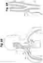 Fig. 08 - Implant tool and improved electrode design for minimally invasive procedure