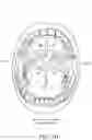Fig. 03 - METHOD AND APPARATUS FOR TREATING SLEEP APNEA