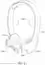 Fig. 14 - Systems, devices, and methods for treating vestibular conditions
