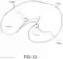 Fig. 15 - Systems, devices, and methods for treating vestibular conditions