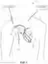 Fig. 02 - Multi-axis coil for implantable medical device
