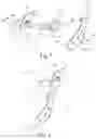 Fig. 02 - Temporo-mandibular prosthesis