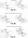 Fig. 04 - Method to reduce etch variation using ion implantation