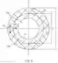 Fig. 05 - SHAPE MEMORY ANCHOR FOR UMBILICAL TERMINATION