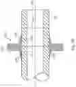 Fig. 09 - SHAPE MEMORY ANCHOR FOR UMBILICAL TERMINATION