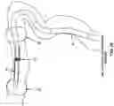 Fig. 28 - METHOD AND APPARATUS FOR PROVIDING INCREASED VISUALIZATION AND MANIPULATION OF A BODY SIDE WALL