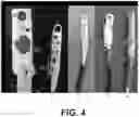 Fig. 04 - Wireless bowel sensor