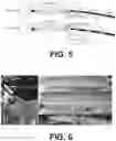 Fig. 05 - Wireless bowel sensor