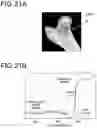 Fig. 17 - Device and system for determining a bone strength indicator