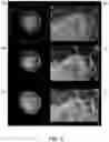 Fig. 07 - Waveform enhanced reflection and margin boundary characterization for ultrasound tomography