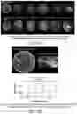 Fig. 12 - Waveform enhanced reflection and margin boundary characterization for ultrasound tomography