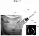 Fig. 03 - Wirelessly programmable transducer-based remote control with inertial sensor