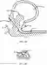 Fig. 12 - Expandable tissue engagement apparatus and method