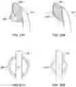 Fig. 22 - Expandable tissue engagement apparatus and method
