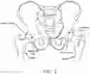 Fig. 03 - Method and apparatus for re-attaching the labrum to the acetabulum, including the provision and use of a novel suture anchor system