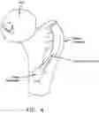 Fig. 05 - Method and apparatus for re-attaching the labrum to the acetabulum, including the provision and use of a novel suture anchor system