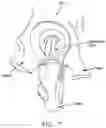 Fig. 08 - Method and apparatus for re-attaching the labrum to the acetabulum, including the provision and use of a novel suture anchor system
