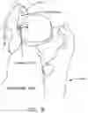 Fig. 09 - Method and apparatus for re-attaching the labrum to the acetabulum, including the provision and use of a novel suture anchor system