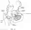 Fig. 10 - Method and apparatus for re-attaching the labrum to the acetabulum, including the provision and use of a novel suture anchor system
