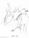 Fig. 11 - Method and apparatus for re-attaching the labrum to the acetabulum, including the provision and use of a novel suture anchor system