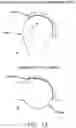 Fig. 14 - Method and apparatus for re-attaching the labrum to the acetabulum, including the provision and use of a novel suture anchor system