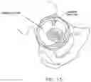 Fig. 16 - Method and apparatus for re-attaching the labrum to the acetabulum, including the provision and use of a novel suture anchor system