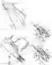 Fig. 03 - Post-Implantation Tension Adjustment in Cardiac Implants