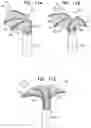 Fig. 24 - Tissue anchors with hemostasis seal