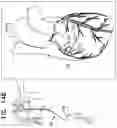 Fig. 31 - Tissue anchors with hemostasis seal