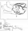Fig. 32 - Tissue anchors with hemostasis seal