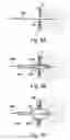 Fig. 09 - DEFLECTABLE GUIDE CATHETERS AND RELATED METHODS