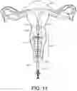 Fig. 12 - Artificial insemination system and method of use
