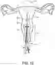 Fig. 13 - Artificial insemination system and method of use