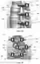 Fig. 05 - Device for Realignment, Stabilization, and Prevention of Progression of Abnormal Spine Curvature