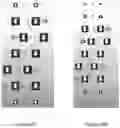 Fig. 24 - Device for Realignment, Stabilization, and Prevention of Progression of Abnormal Spine Curvature