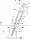 Fig. 07 - Apparatus, system, and method for spinal vertebrae stabilization