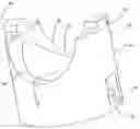 Fig. 01 - Variable angle spinal screw assembly with press fitment bushing