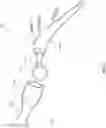 Fig. 12 - Prosthesis installation