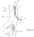 Fig. 06 - Method and apparatus for percutaneous epicardial ablation of cardiac ganglionated plexi without myocardial injury