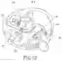 Fig. 07 - Method and apparatus for percutaneous epicardial ablation of cardiac ganglionated plexi without myocardial injury