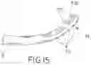 Fig. 10 - Method and apparatus for percutaneous epicardial ablation of cardiac ganglionated plexi without myocardial injury