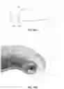 Fig. 13 - SYSTEMS AND METHODS FOR TISSUE DISPLACEMENT